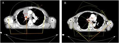 Predicting radiation pneumonitis in lung cancer: a EUD-based machine learning approach for volumetric modulated arc therapy patients